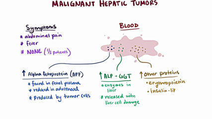 Malignant liver tumors - causes symptoms diagnosis treatment pathology