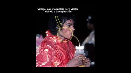 Michael Jackson Vitiligo