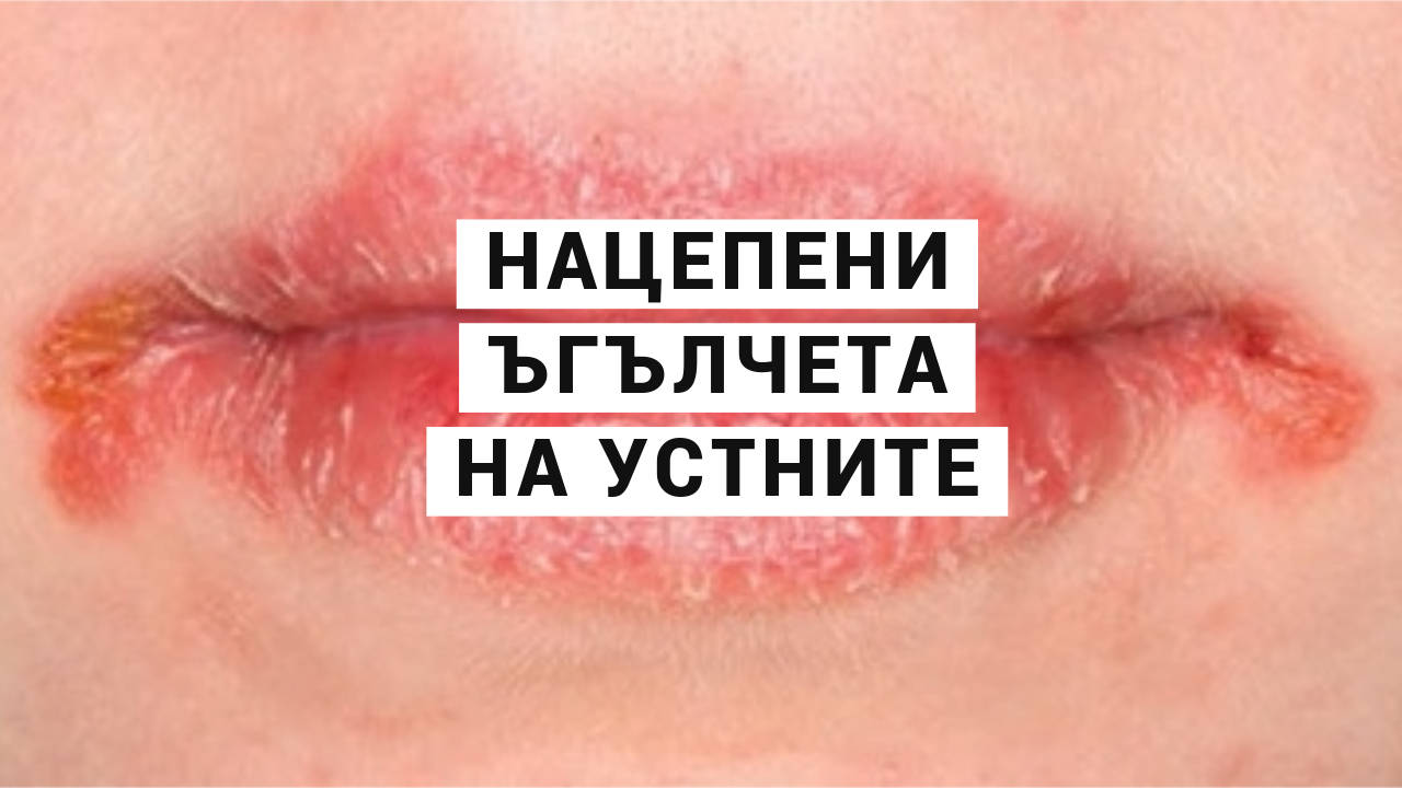 НАЦЕПЕНИ ЪГЪЛЧЕТА НА УСТНИТЕ - причини и лечение