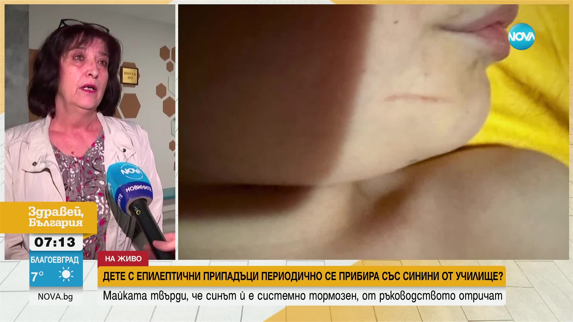 Дете с епилептични припадъци периодично се прибира със синини от училище