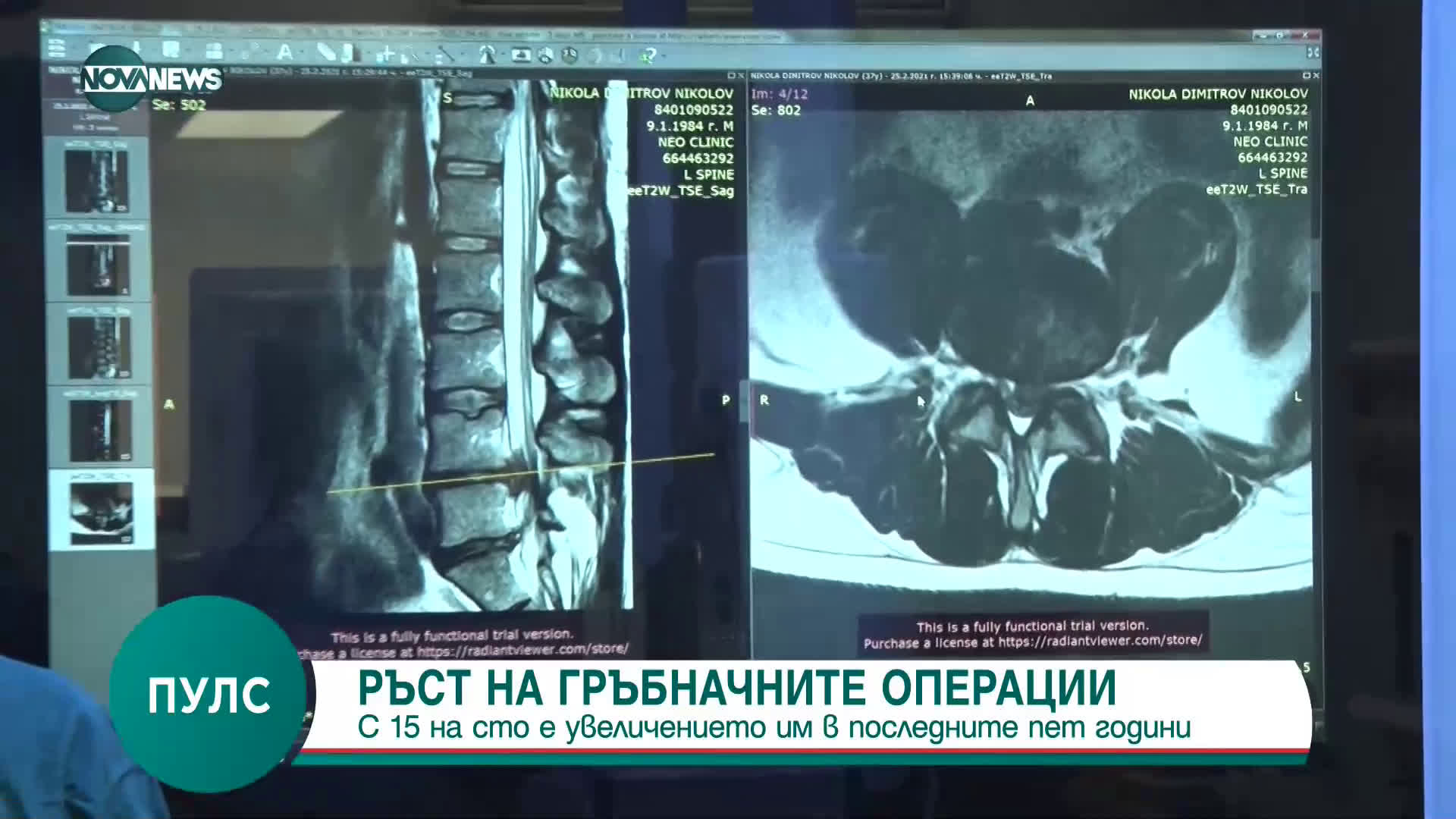 "Пулс": С 15 % са се увеличили гръбначните операции