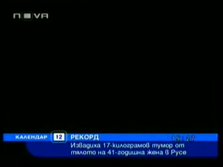 Рекорд ! 17 - килограмов Тумор извадиха Медици от 41 - годишна Жена от Русе 