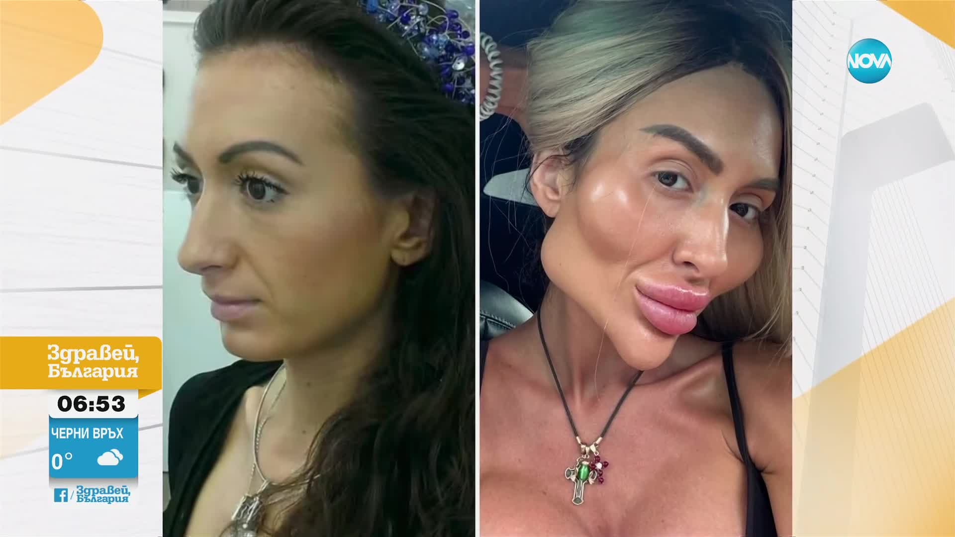 Как е изглеждала преди операциите жената с най-големи скули в света