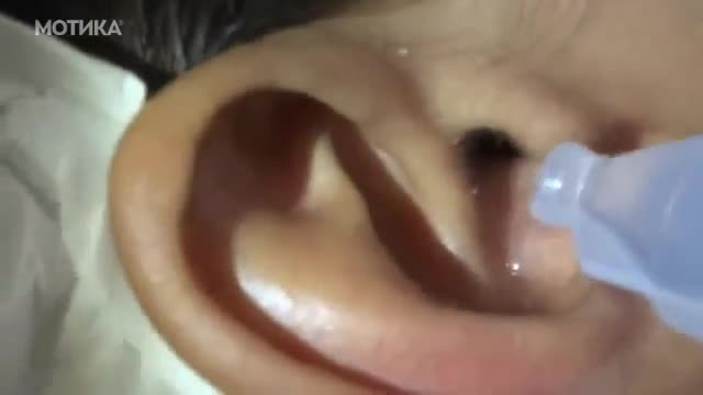 Ето какво откри лекар в ухото на пациент