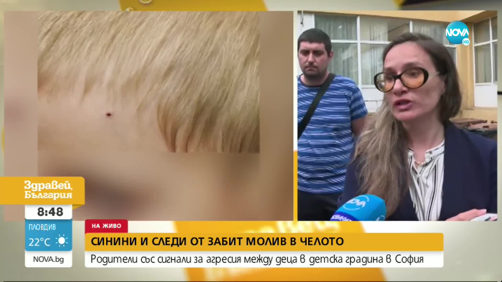 Агресия в детска градина: Синини и следи от забит молив в челото