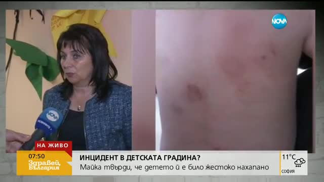 ЕКСПЕРТИЗА: Какво установиха лекарите за нахапаното в Бургас дете?