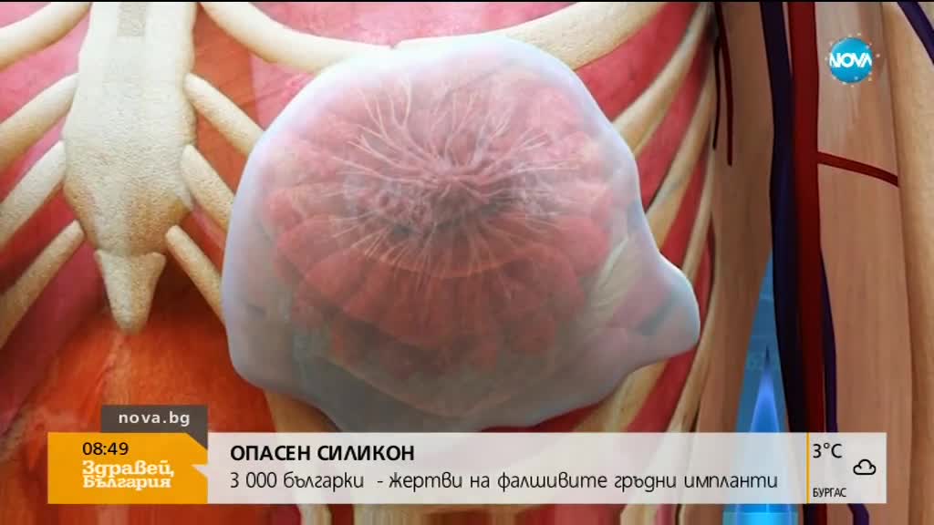 ОПАСЕН СИЛИКОН: 3000 българки са жертви на фалшивите импланти