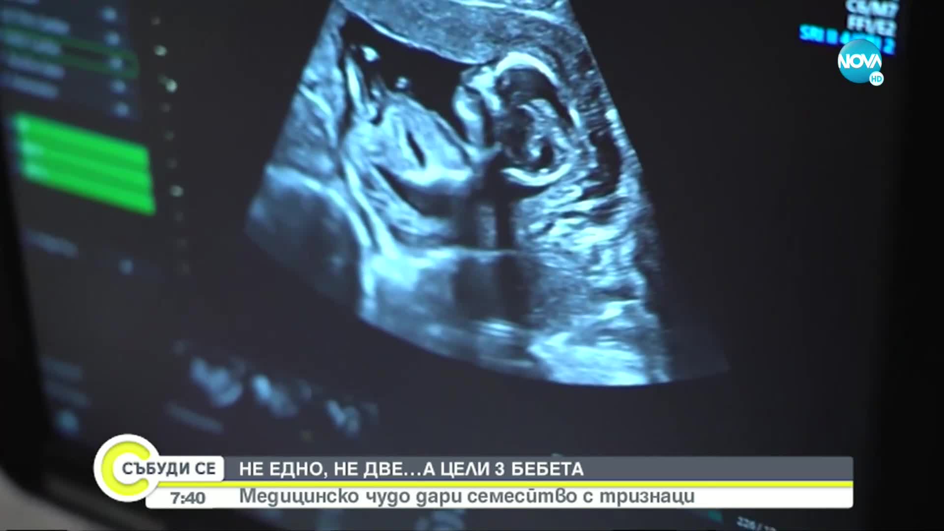 Медицинско чудо: Жена роди тризнаци след имплантирането на само два ембриона