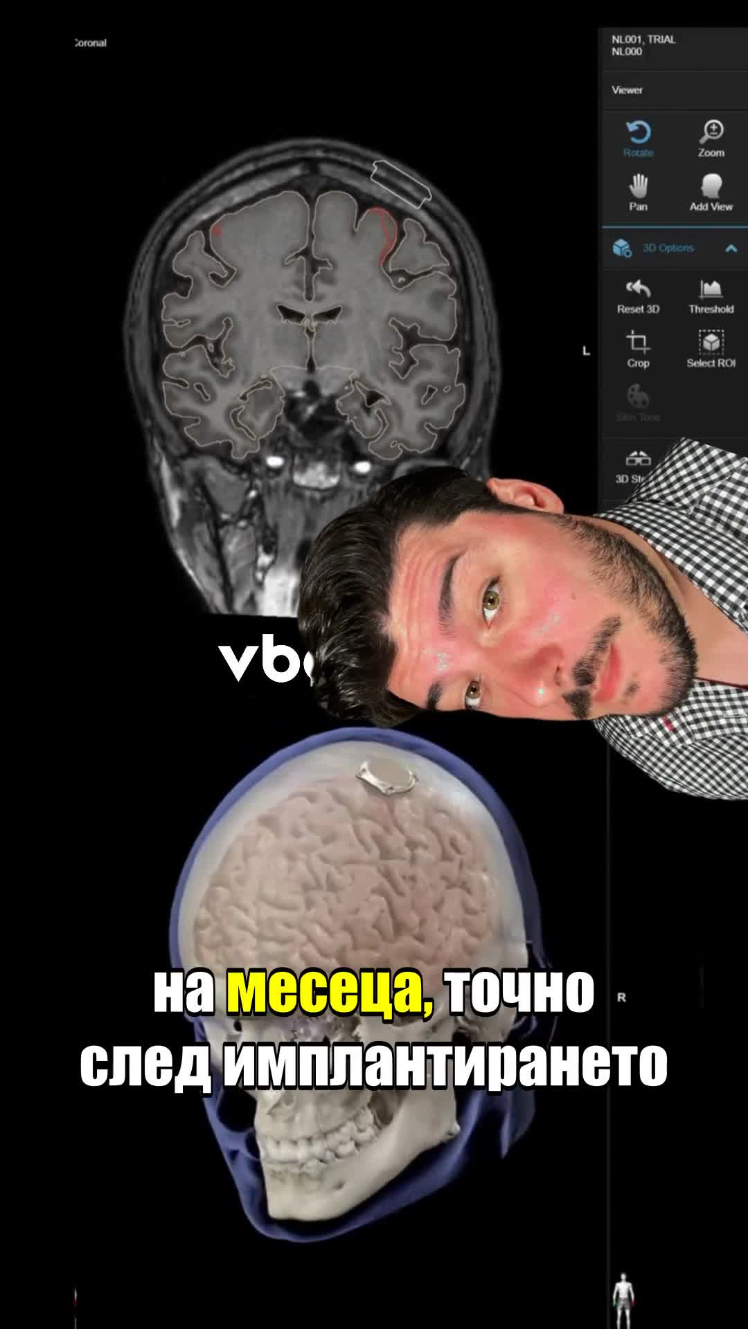 Първият човешки мозъчен имплант на Мъск претърпя сериозен БЪГ!😱😱