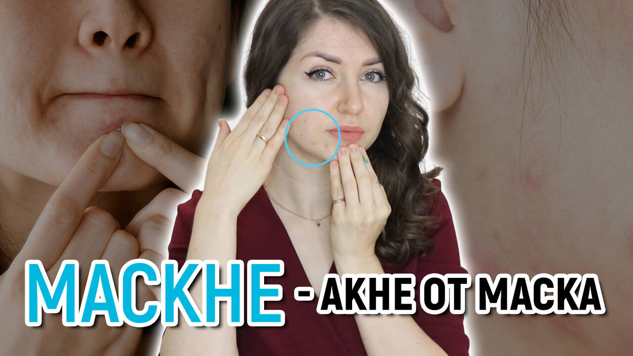 МАСКНЕ - АКНЕ ОТ МАСКА | Как да предотвратите и как да лекувате | ПЪПКИ ОТ НОСЕНЕ НА МАСКА ЗА ЛИЦЕ