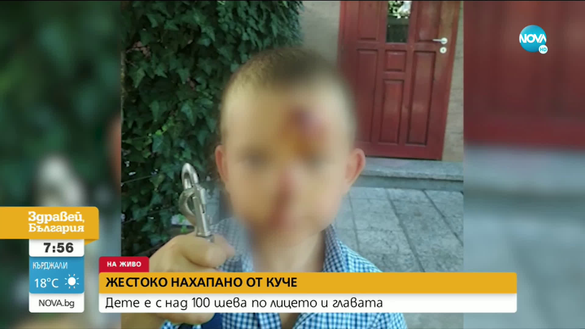 Детето, нахапано от куче край Пловдив, се хранило със сламка 20 дни