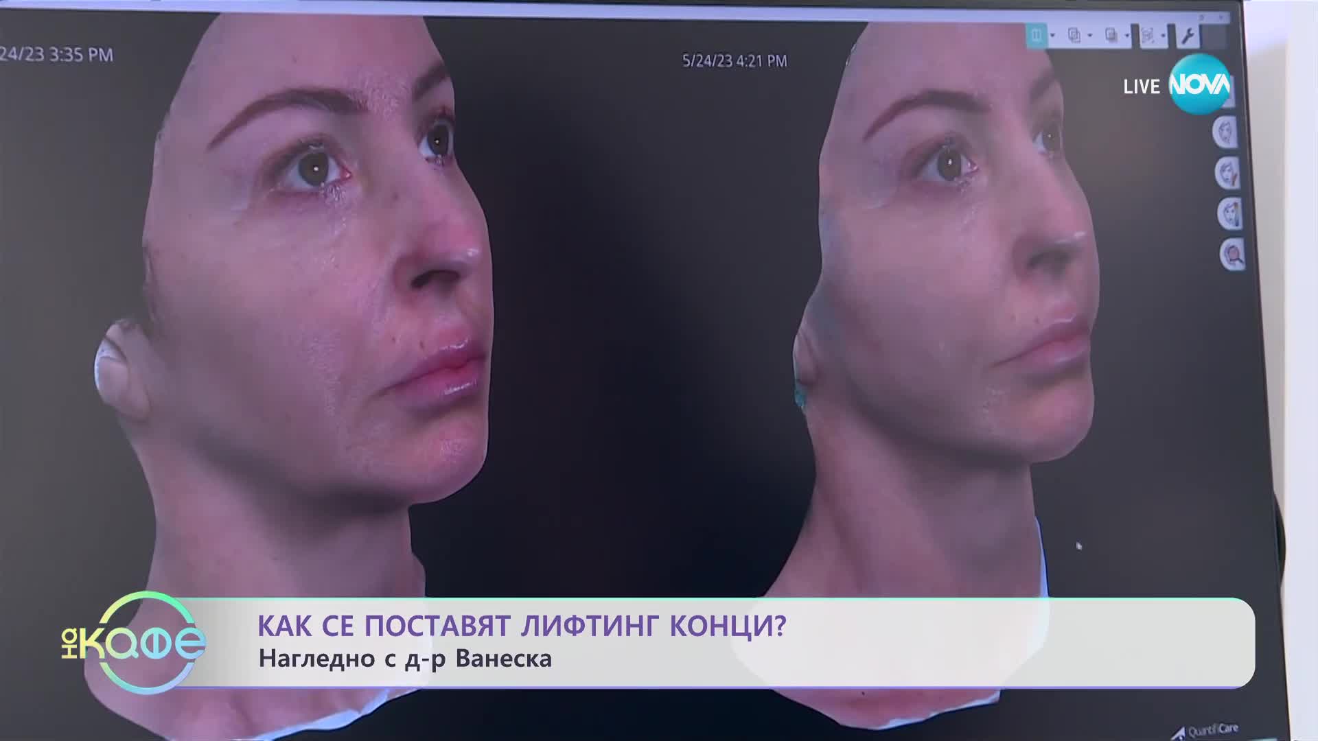 Как се поставят лифтинг конци? - „На кафе” (07.07.2023)