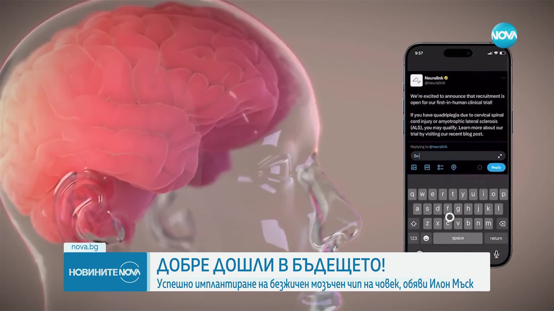 Neuralink на Мъск е имплантирала мозъчен чип на човек